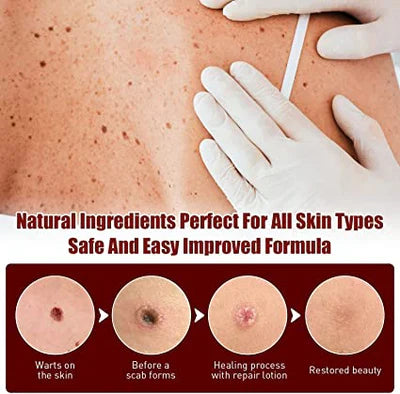 Topical Skin Tag Remover Solution with Tea Tree Oil and Arborvitae Extract