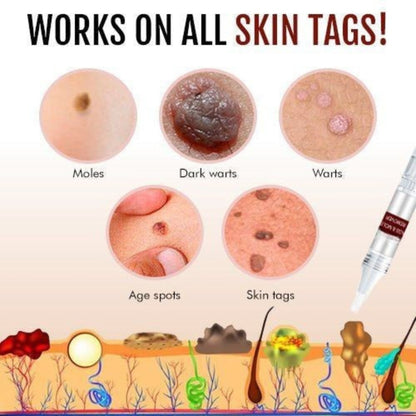 Topical Skin Tag Remover Solution with Tea Tree Oil and Arborvitae Extract