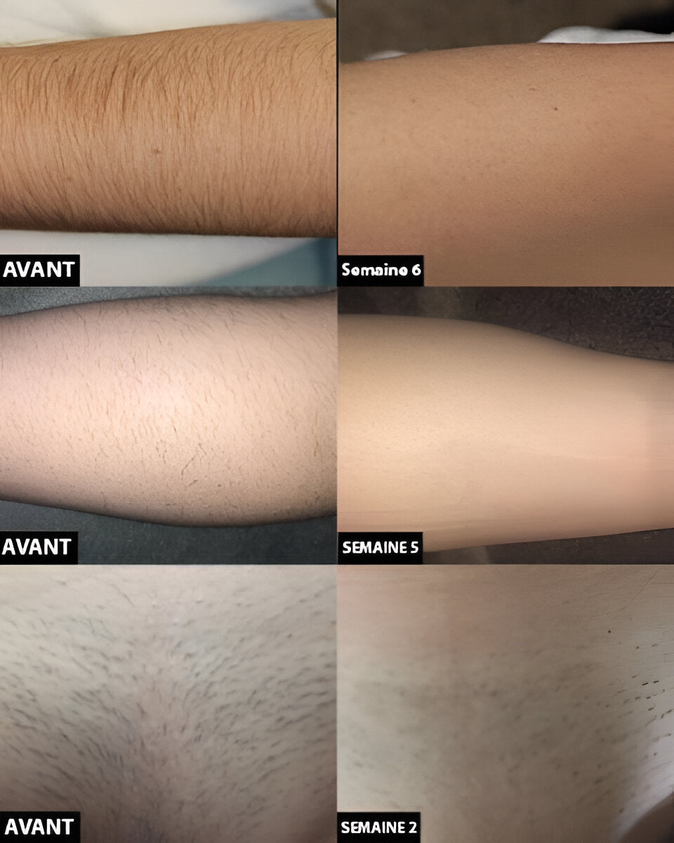Light Based Hair Remover with Skin Contact Sensor and Progressive Reduction
