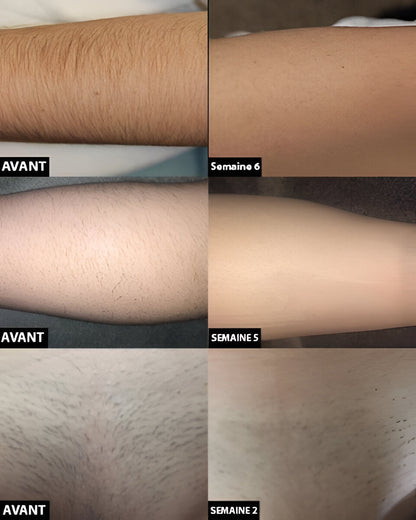 Light Based Hair Remover with Skin Contact Sensor and Progressive Reduction